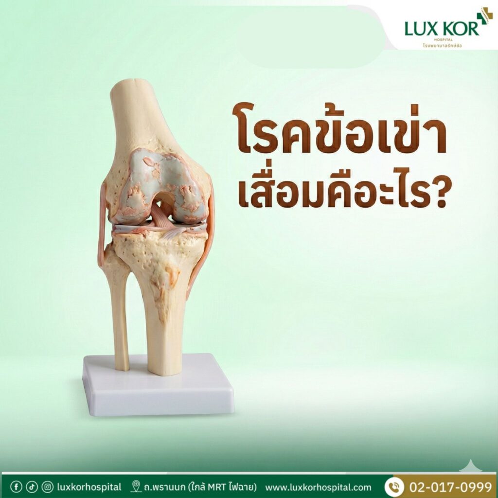 โรคข้อเข่าเสื่อมเกิดจากการเสื่อมของกระดูกอ่อนผิวข้อ