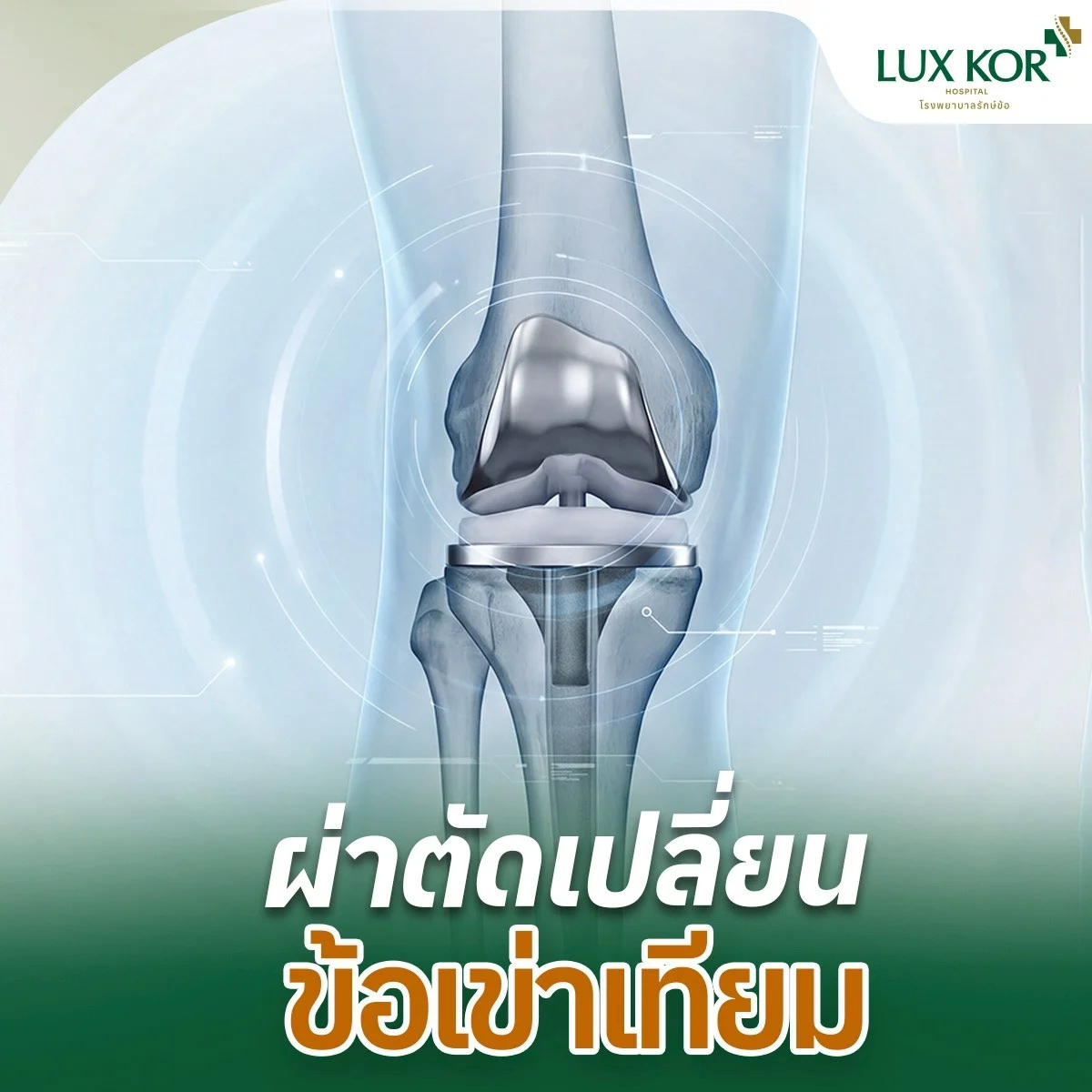 แพ็กเกจผ่าตัดเปลี่ยนข้อเข่าเทียม (TKR)