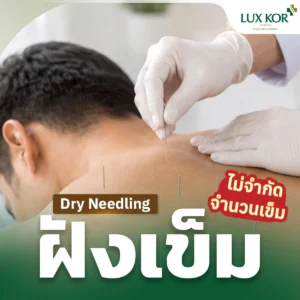แพ็กเกจฝังเข็มแบบตะวันตก (Dry Needling) รักษาออฟฟิศซินโดรมและปวดเรื้อรัง