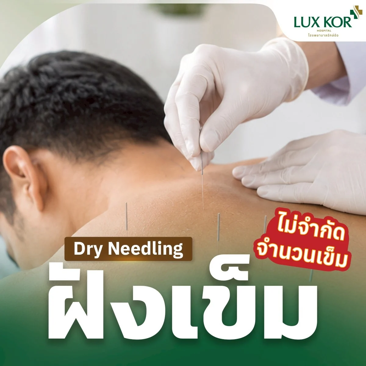 แพ็กเกจฝังเข็มแบบตะวันตก (Dry Needling) รักษาออฟฟิศซินโดรมและปวดเรื้อรัง