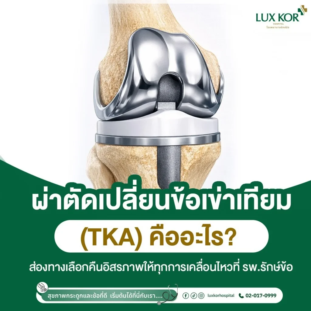 การผ่าตัดเปลี่ยนข้อเข่าเทียม TKA และการฟื้นฟูสมรรถภาพข้อเข่าโดยทีมแพทย์เฉพาะทาง โรงพยาบาลรักษ์ข้อ